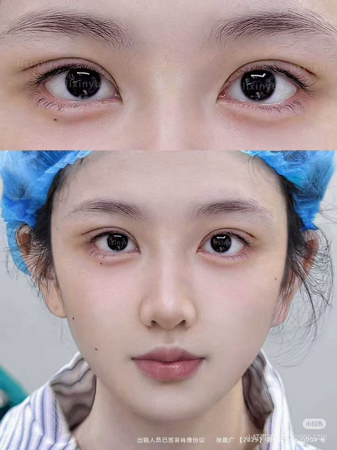 รีวิว ศัลยกรรมจีน ปรับรูปตา